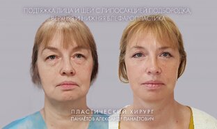 Блефаропластика
