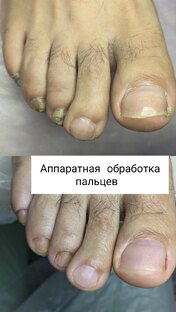 Аппаратный педикюр 