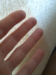 Про артроз кистей рук