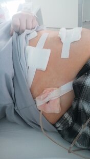 мне удалили желчный пузырь 