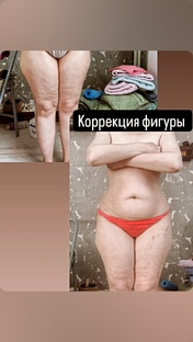 Коррекция целлюлита 