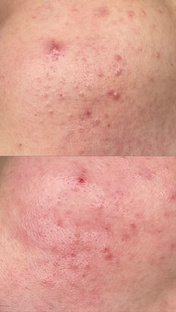 Чистка лица