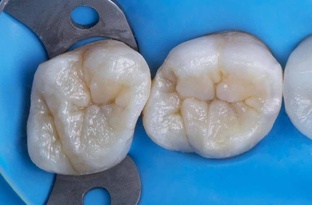 Пломбы и кариес