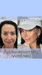 Антивозрастная пластика