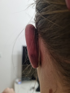 Отопластика 