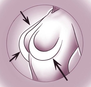 Пластика груди 