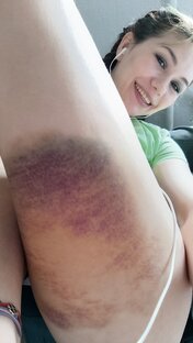 травма ноги и её заживление 