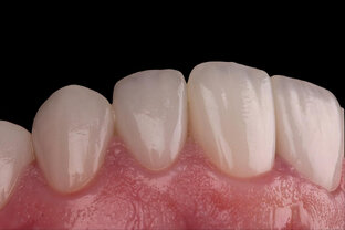 ВИНИРЫ. СЕКРЕТЫ ИДЕАЛЬНОЙ УЛЫБКИ!