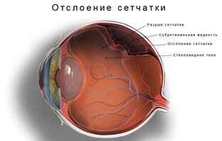 Отслойка сетчатки