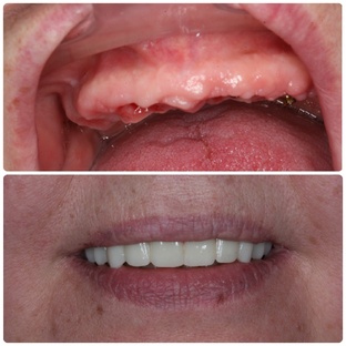 ВОССТАНОВЛЕНИЕ ЗУБОВ: имплантация и ортопедия