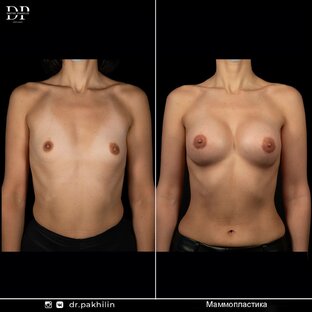 Увеличение груди | +7 925 767 40 14