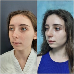 Ринопластика