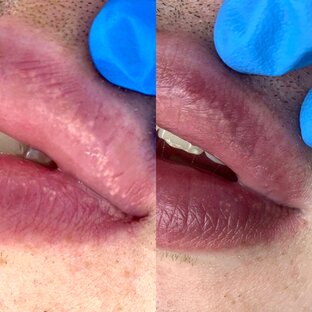 Гранулы фордайса