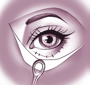 Нижняя блефаропластика 