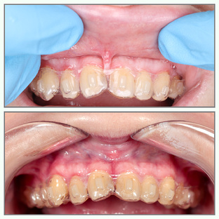 Немного хирургии 