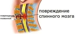 Родовые травмы шейного отдела 
