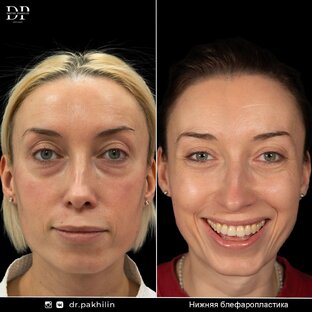Нижняя блефаропластика | +7 925 767 40 14
