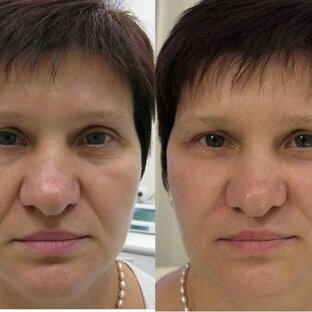 Плазмолифтинг 