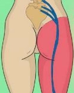ИШИАС (ЗАЩЕМЛЕНИЕ СЕДАЛИЩНОГО НЕРВА). ЛЕЧЕНИЕ НАРОДНЫМИ СРЕДСТВАМИ