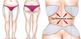 Липосакция и липомоделирование