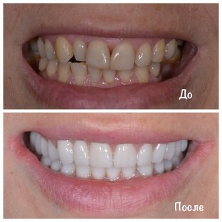 Коронки и виниры на зубы