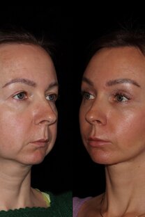 Этапное омоложение лица