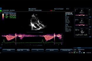 Эхокардиография (УЗИ сердца)