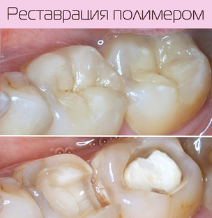 Реставрация зуба полимером
