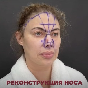 Реконструктивные операции после ДТП