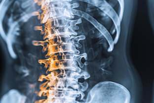 Грыжа диска позвоночника