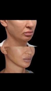 Фейслифтинг