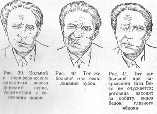 Паралич лицевого нерва