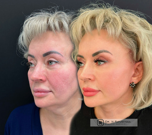 Операции на лице и шее