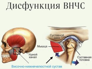 ДИСФУНКЦИЯ ВНЧС