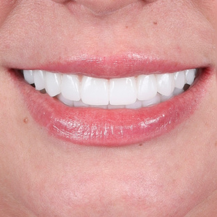 Циркониевые имплантаты 