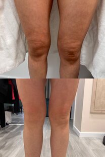 Процедура SlimTight