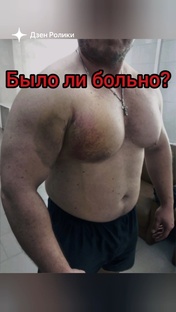 Оторвал грудную мышцу. Восстановление