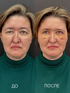 Хирургия старых травм на лице, ассиметрий, парезов