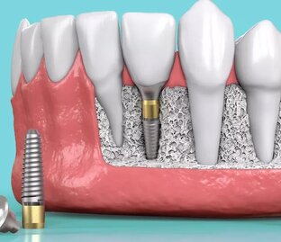 ИМПЛАНТАЦИЯ. ВСЕ, ЧТО НУЖНО ЗНАТЬ!