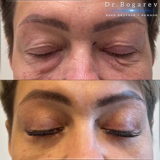 Блефаропластика