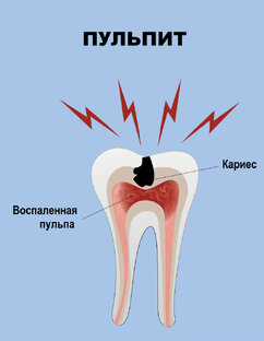 Пульпит (2-х канальный)