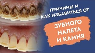 Уход за полостью рта