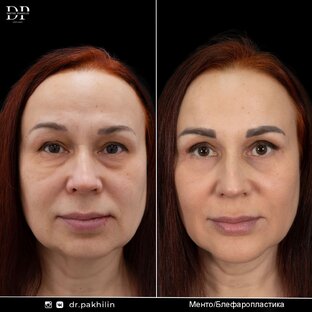 Блефаропластика (Круговая расширенная )