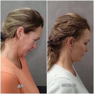 Хирургическое омоложение лица