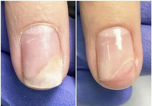 Ониходистрофии