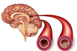 АТЕРОСКЛЕРОЗ СОСУДОВ ГОЛОВНОГО МОЗГА