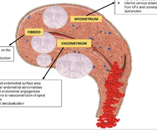 Миома матки