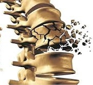 Остеопороз и переломы