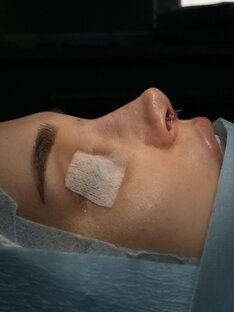 Первичная ринопластика