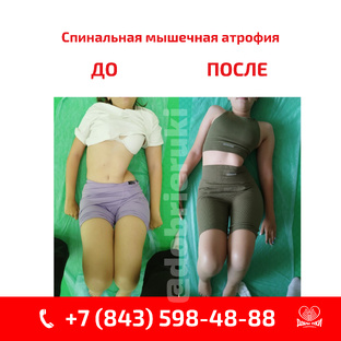 О Спинальной мышечной атрофии 